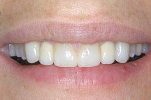 After Cosmetic Dentistry Rejuvenation