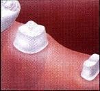 no anaesthetic dentist cincinnati