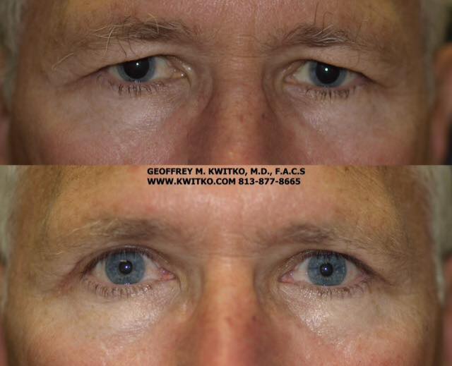 Reconstructive Eyelid Surgery, Tampa, FL